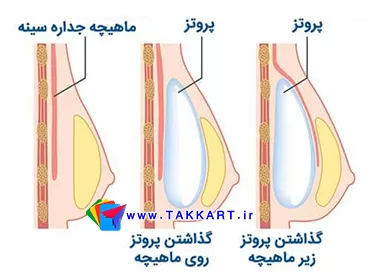 Breast-prosthesis