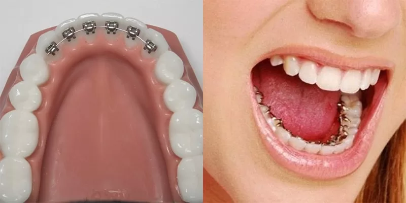 براکت پشت دندانی